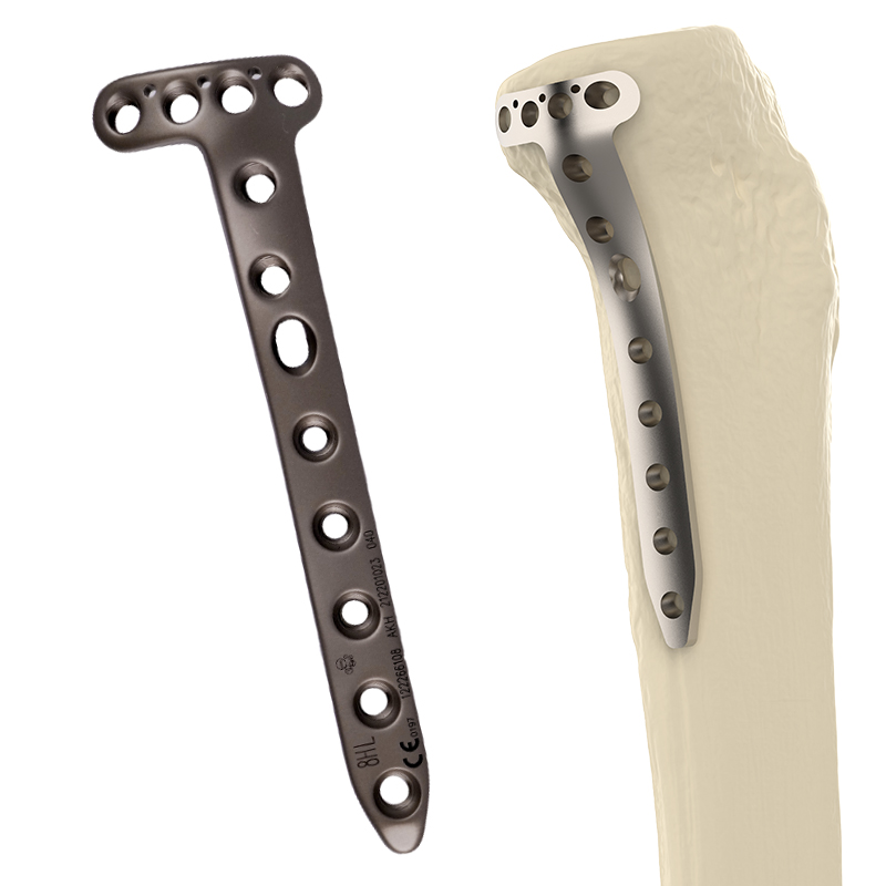 CANWELL Proximal Medial Titanium Tibial Locking Plate Compression Bone Orthopedic Implants Trauma Fracture Surgery OEM CE
