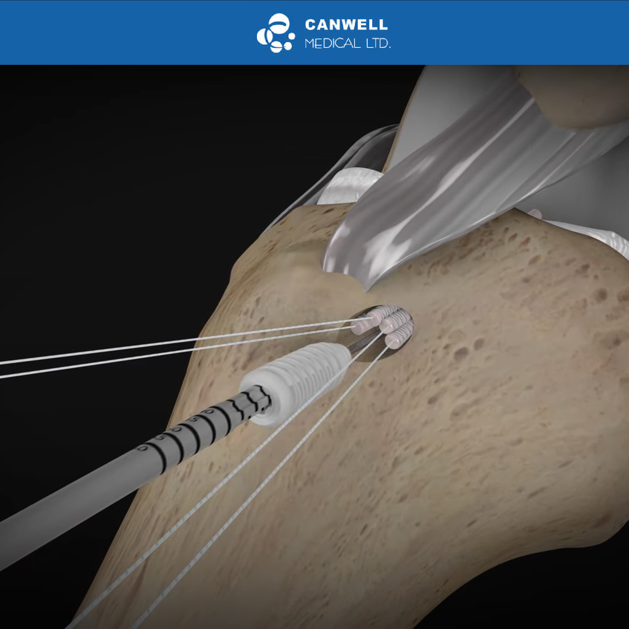 CANWELL ACL Bioabsorbable Screw PLGA Interference Screw ACL/PCL Reconstruction Arthroscopy Surgery Orthopedic Implants CE