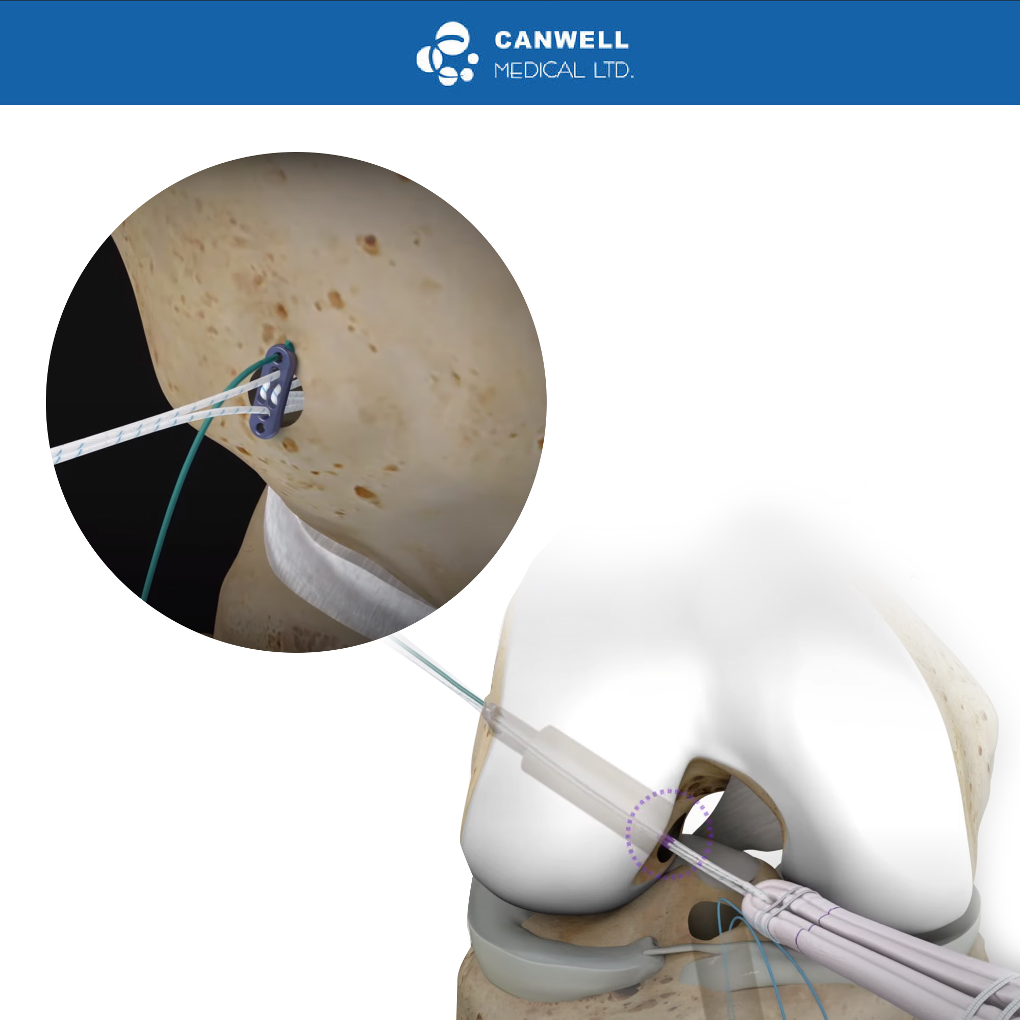 CANWELL Arthroscopy Implants ACL Endobutton Reinforced Button Cl ultra Sports Medicine Medical Orthopedic