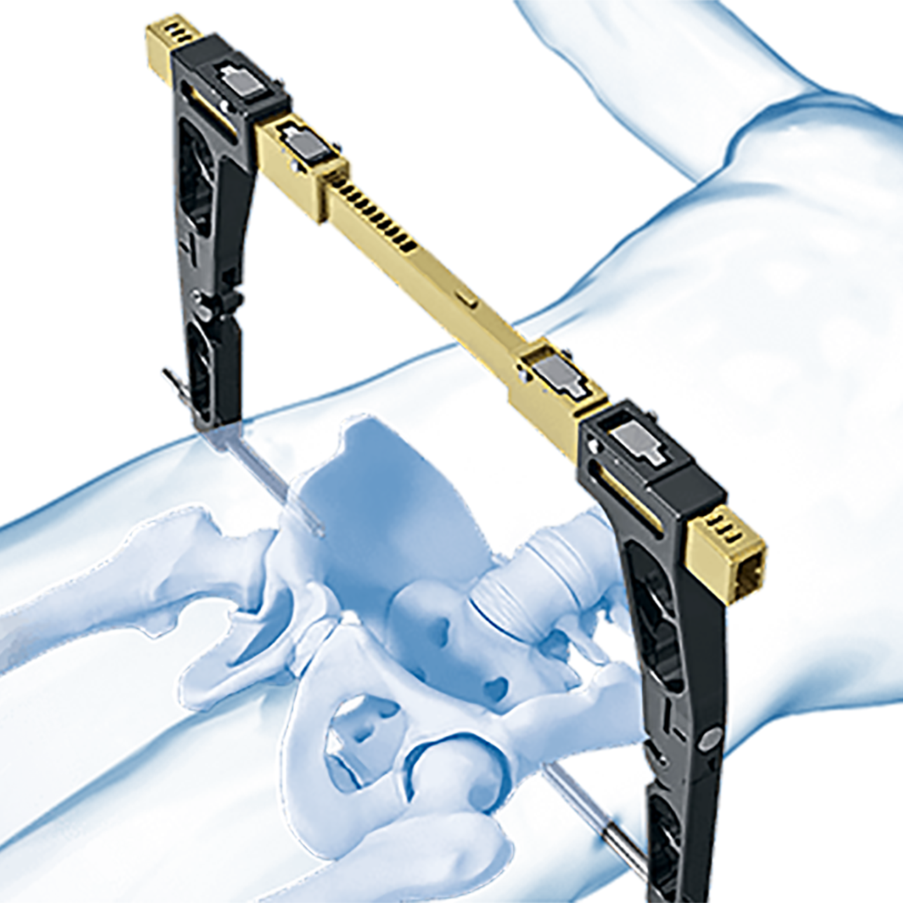 CANWELL CanPCC Pelvis C-Clamp Ii Instrument Set