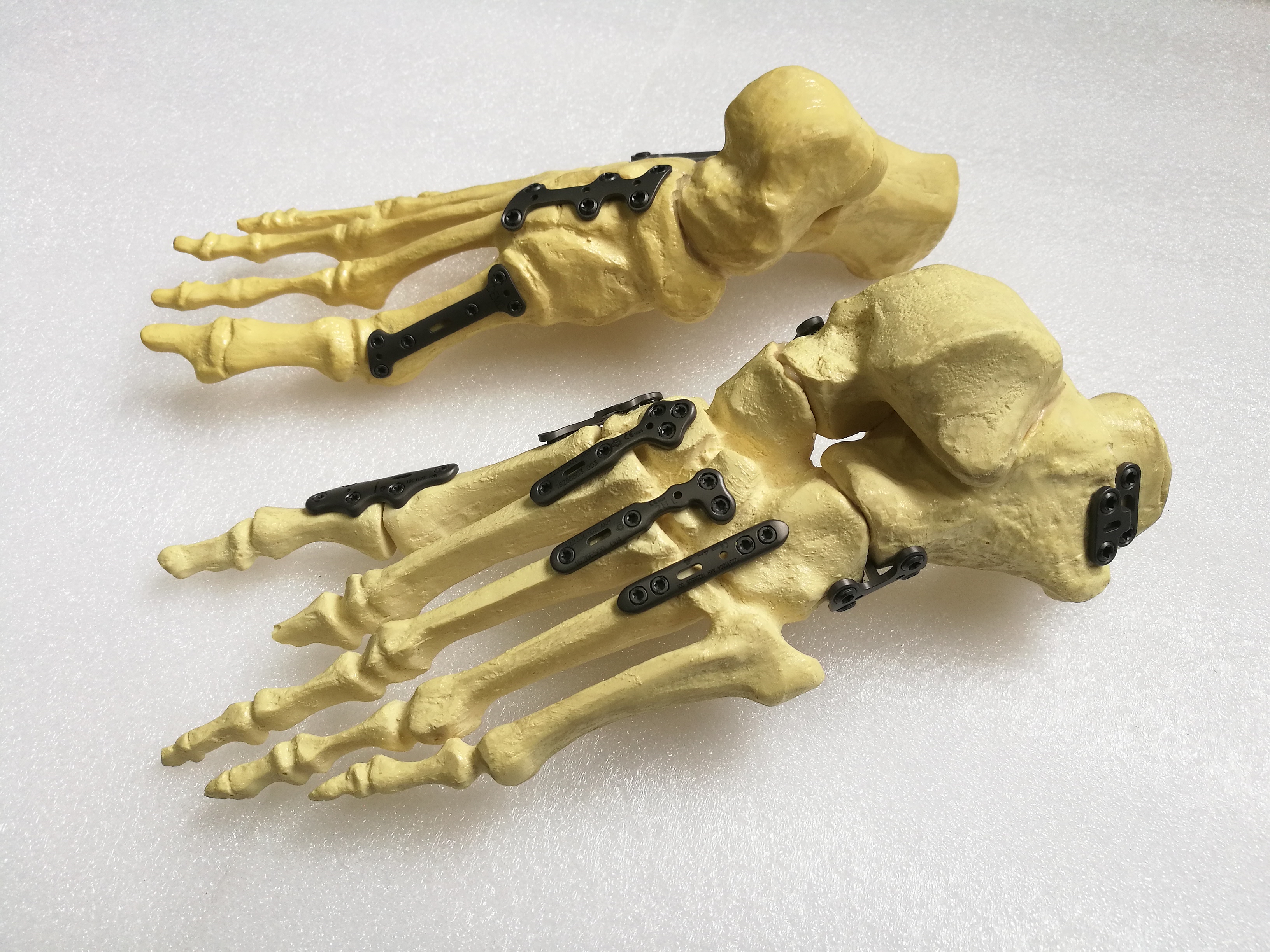 Titanium foot plates trauma