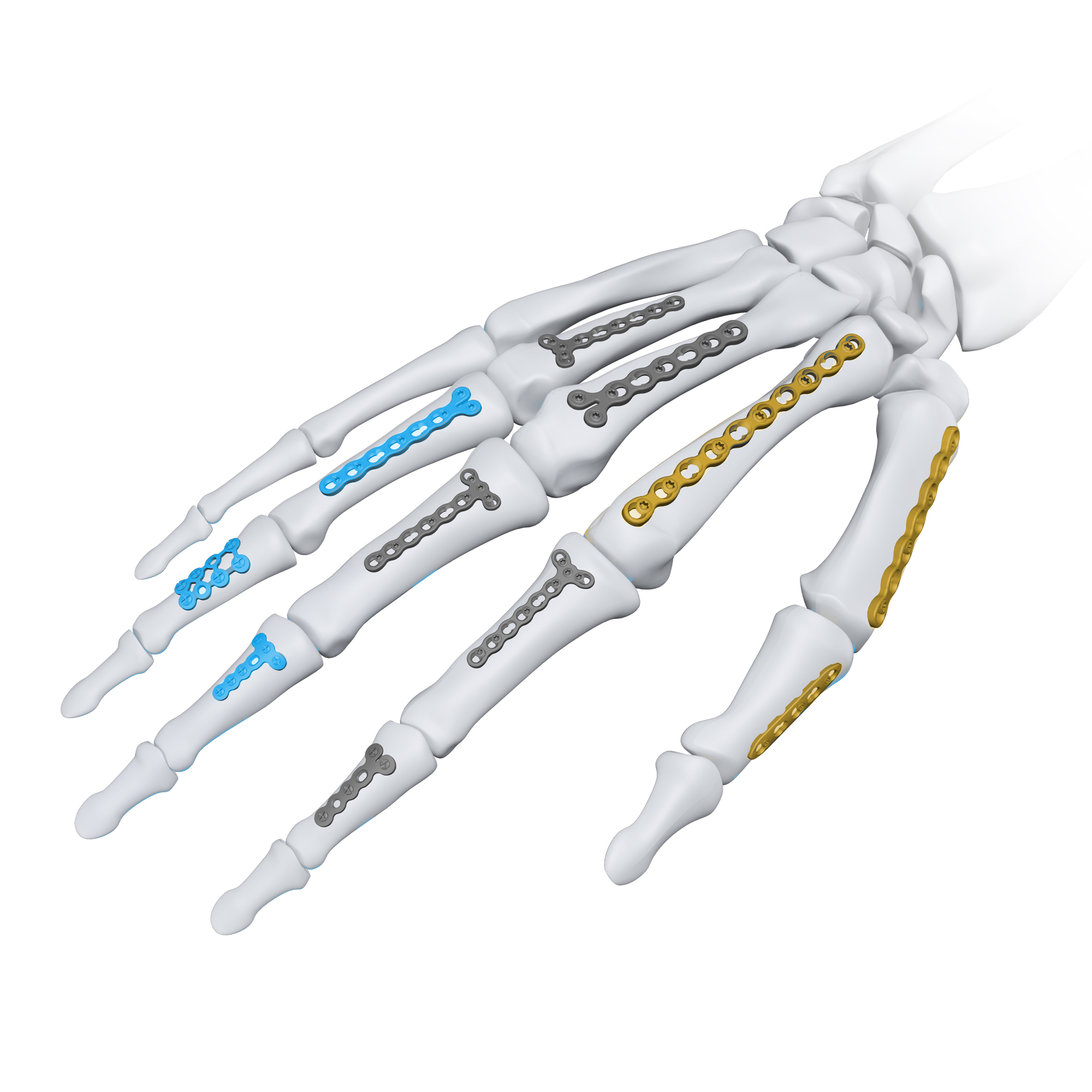 CANWELL Titanium Mini Locking Plate System Orthopedic Trauma Implant for Hand Foot Bone Fracture Fixation Surgery