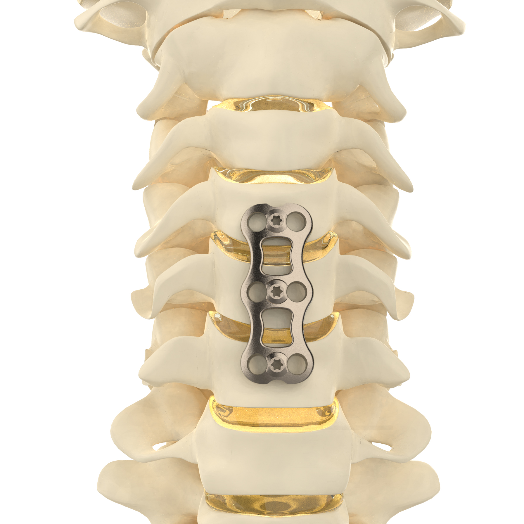 CANWELL Orthopedic Implant Spine Implant Anterior Cervical Bone Plate Cervical Spine Surgery Titanium Plate