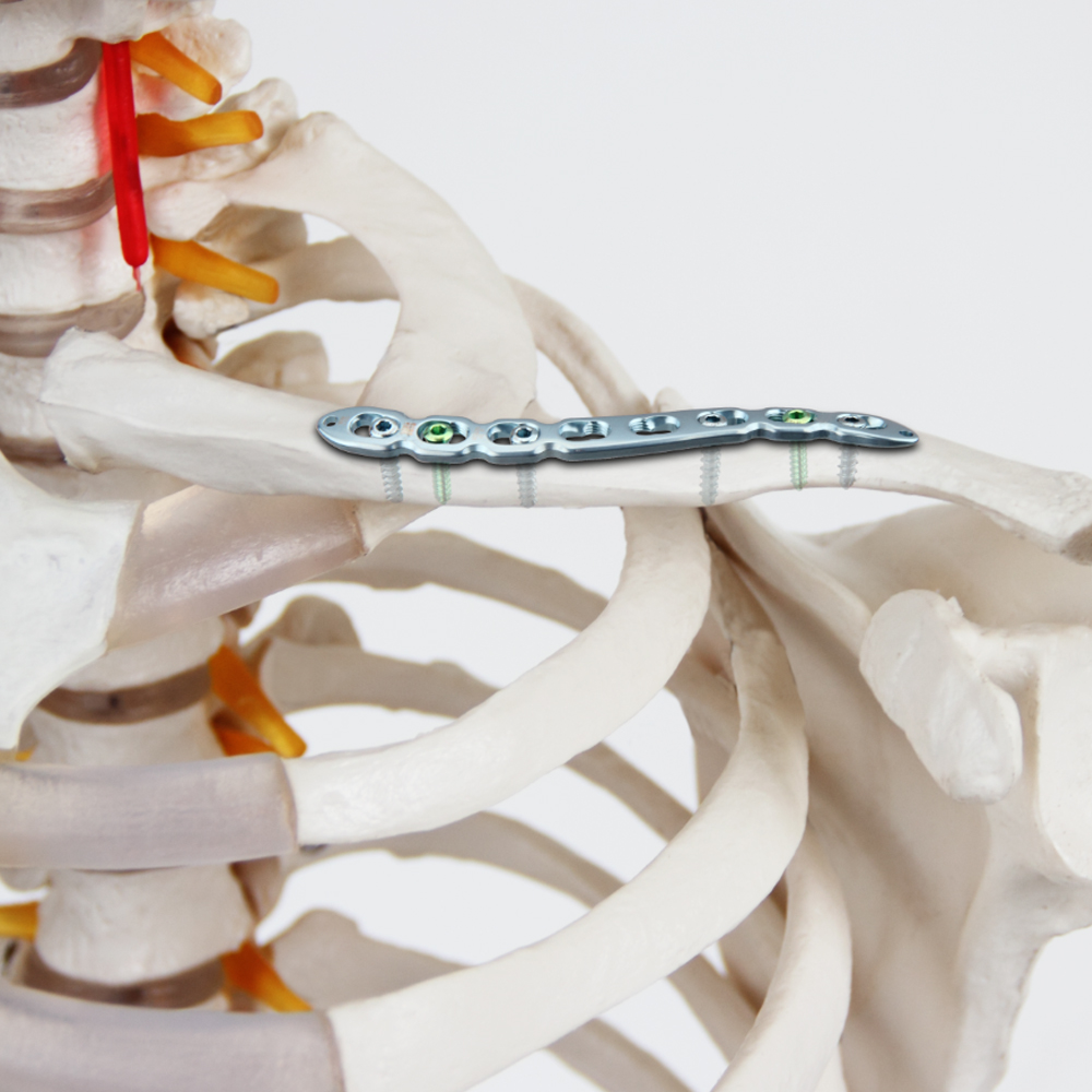 Geasure Midshaft Distal Clavicle Titanium Orthopedic Trauma Reconstruction Locking Implant Hospital Use Class III 1 Year