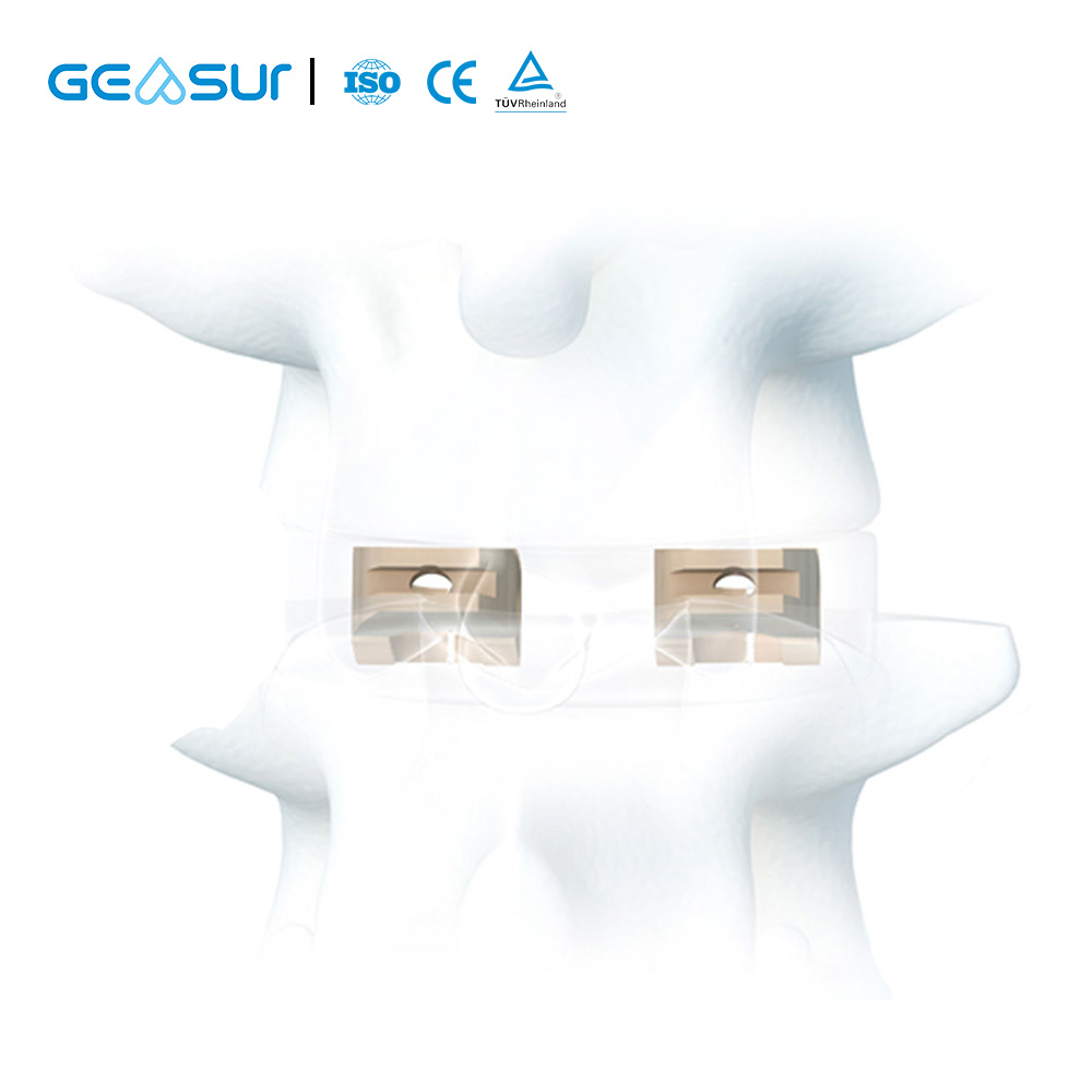 GEASURE TLIF PEEK Cage Lumbar Interbody Fusion for Spine Surgery Orthopaedic Implants CE Certified Class III