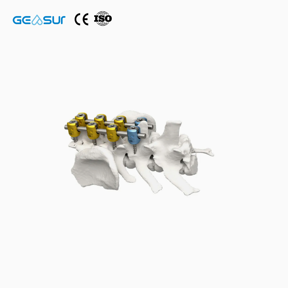 Geasure CE & ISO Certified Titanium Spinal Fixation Pedicle Screw-Class III Orthopedic Implant with 1 Year Warranty Made China
