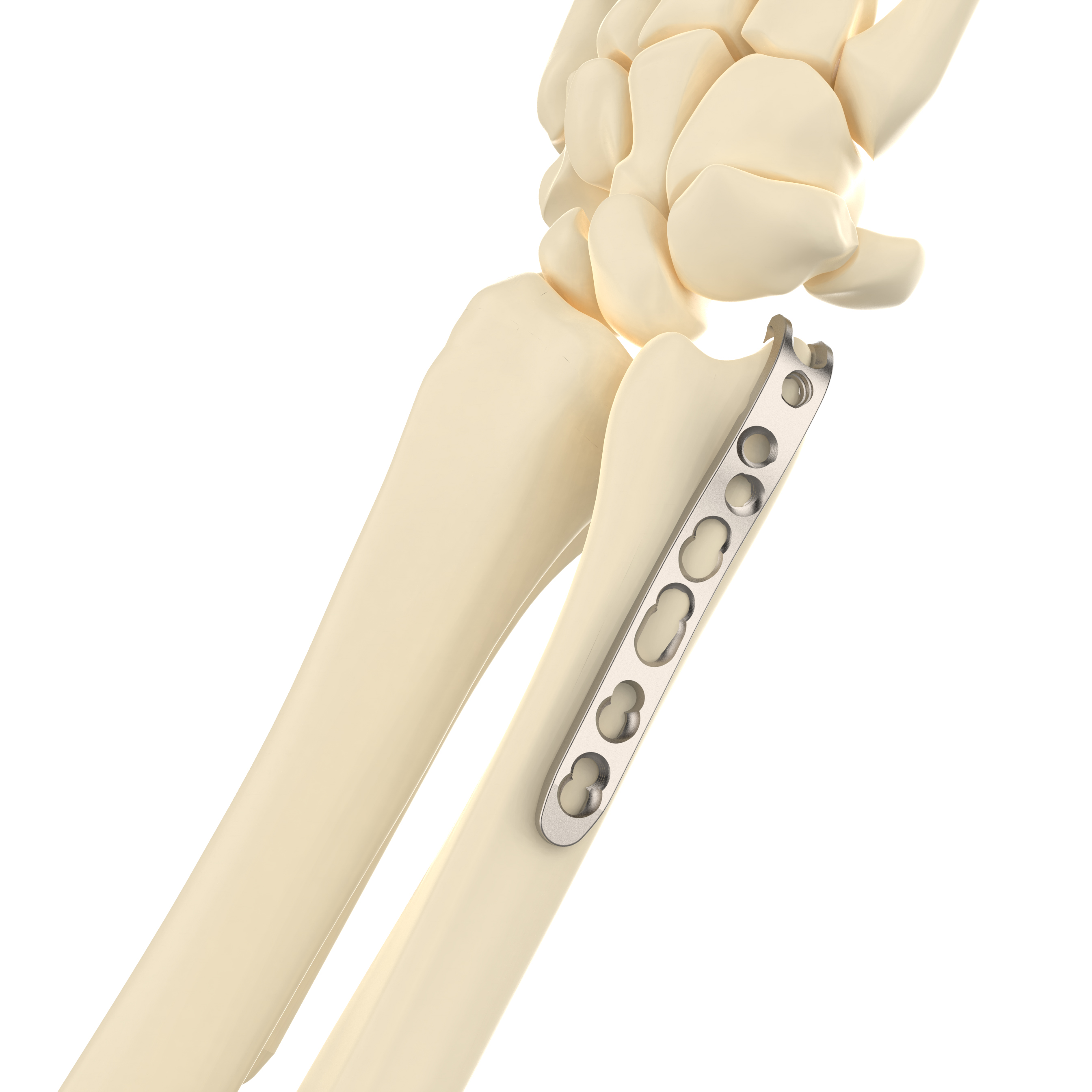 CANWELL Titanium for Distal Ulna Hook Locking Plate Mini Compression Bone Orthopedic Implants Trauma Fracture Surgery CE OEM