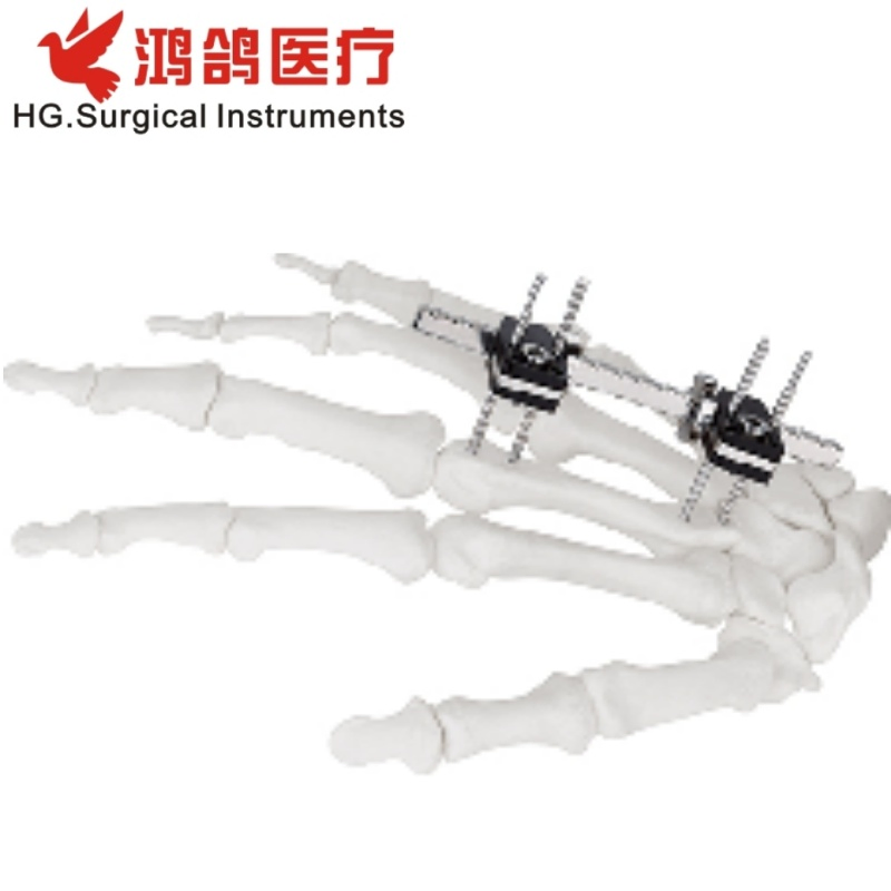 Orthopedic Mini Fixator Joint Motion Type Orthopedic External Orthopedic Products Orthopedic Instrument