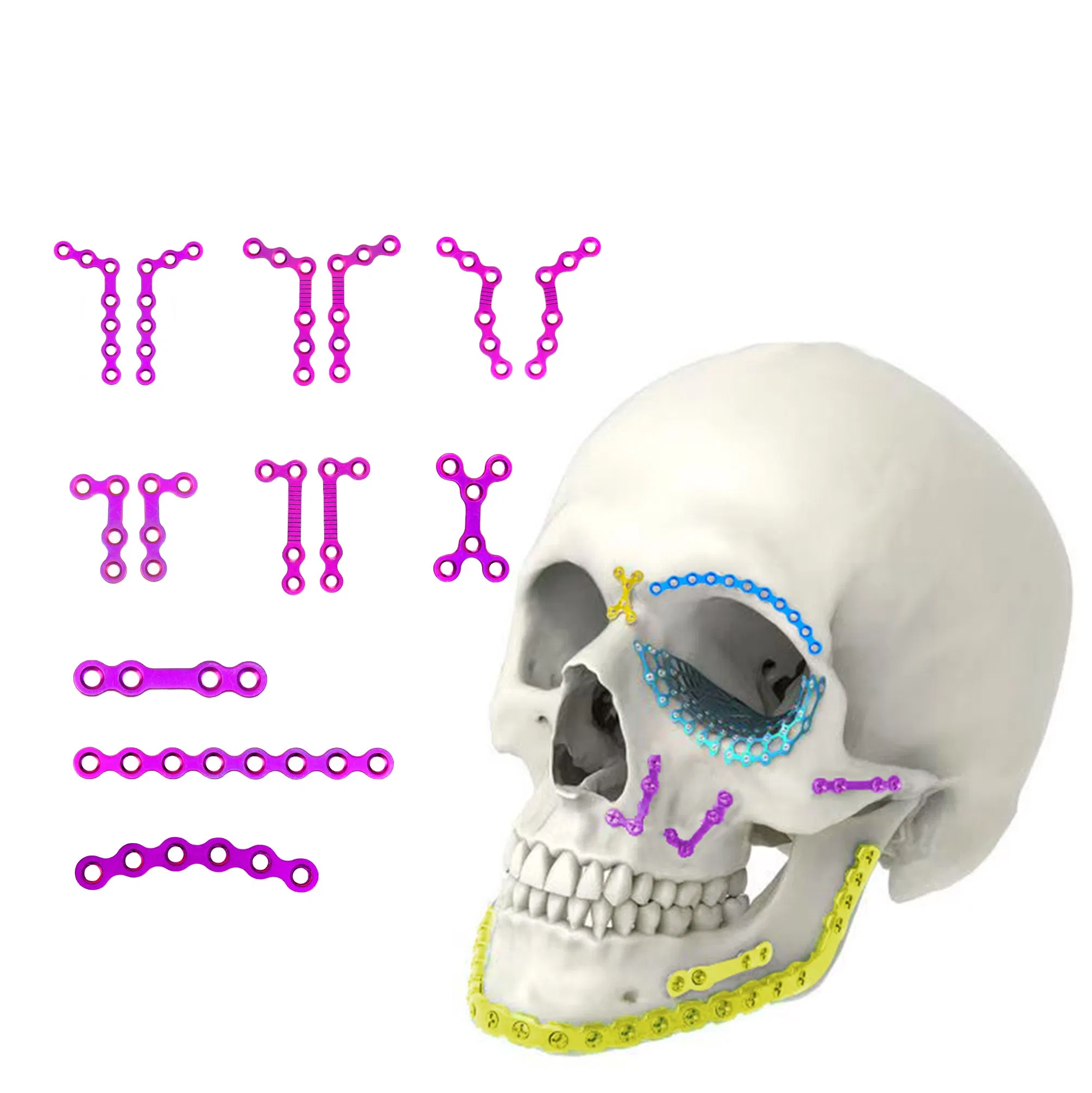 Orthopedic Implant Titanium Alloy Maxillofacial Plates and Screws Locking Plate