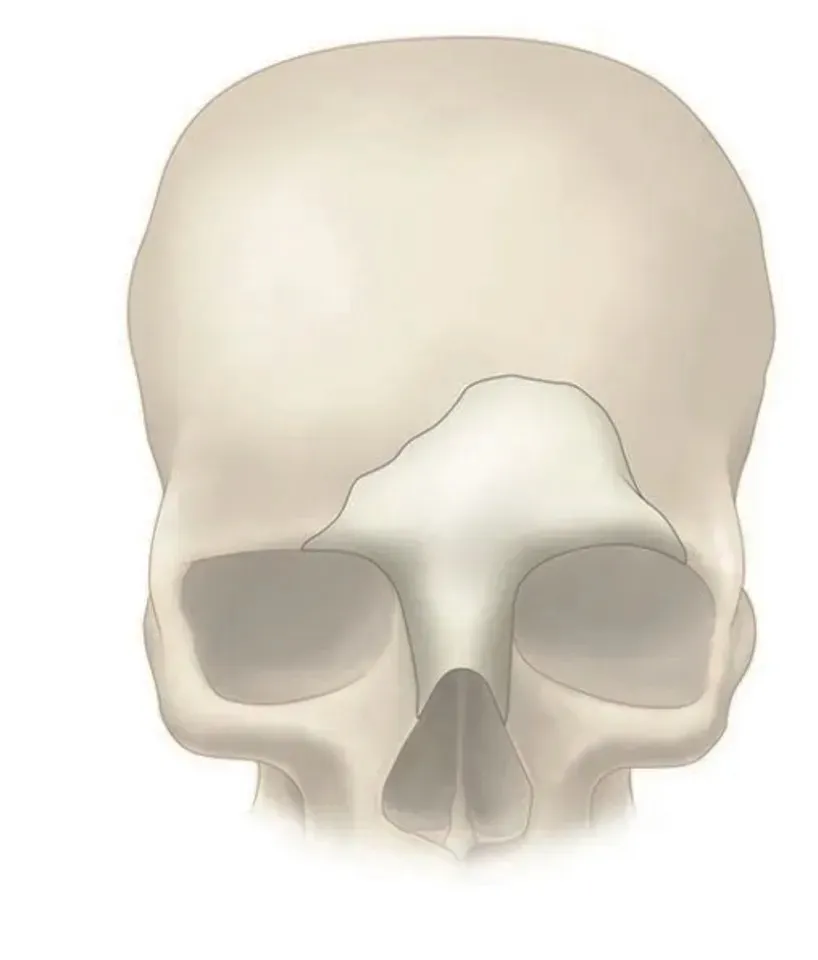 Surgical Peek Implant 5