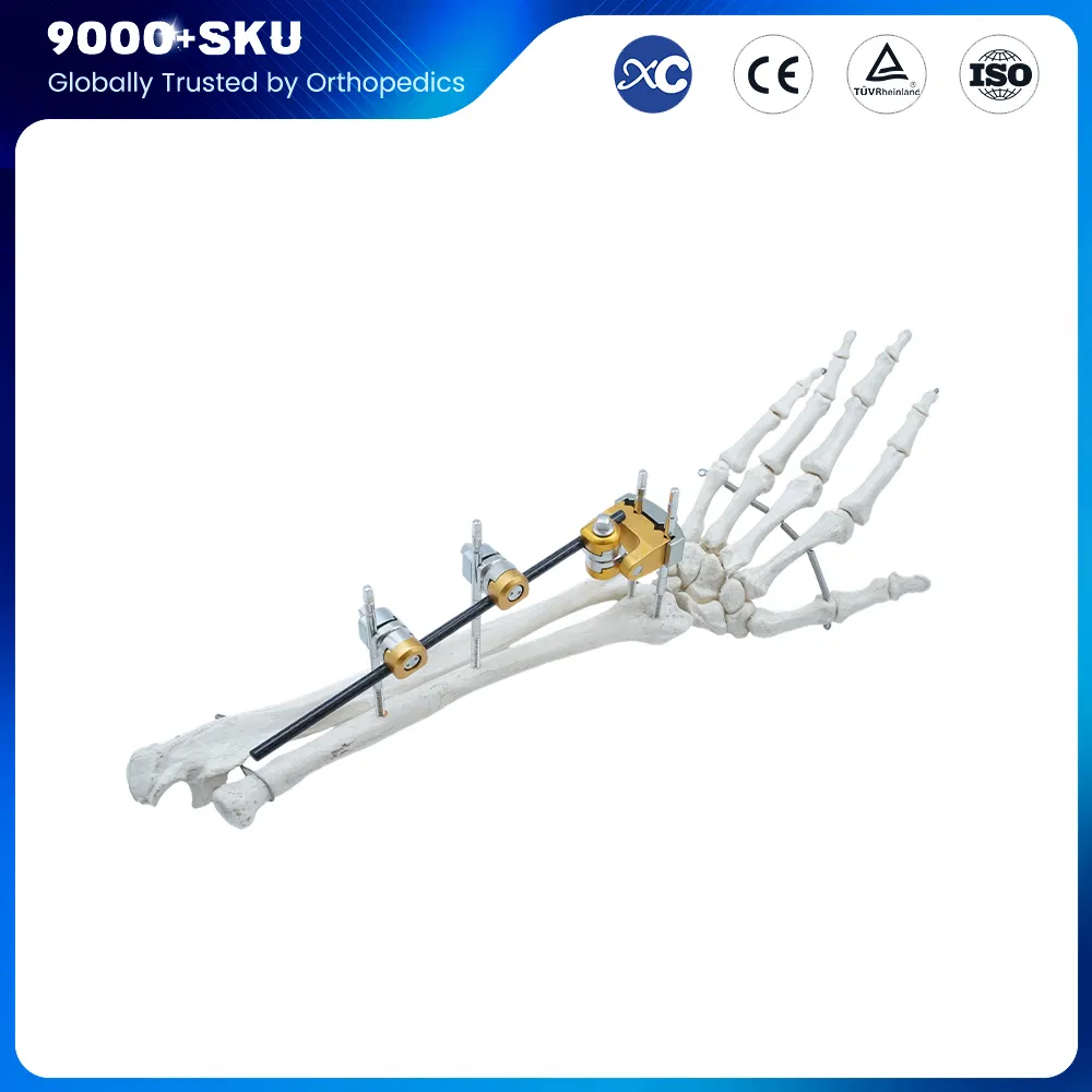 Orthopedic Medical Fracture Fixation Single-Pin Type Upper Limbs Wrist External Fixator