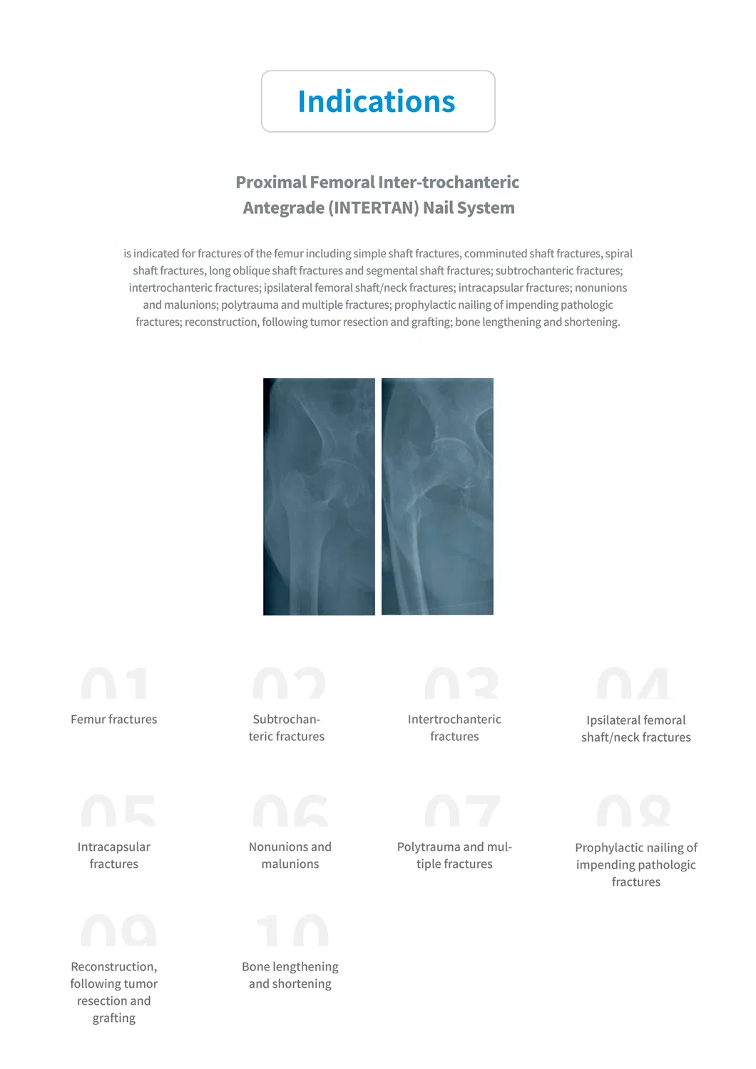 Fracture Surgery Implant