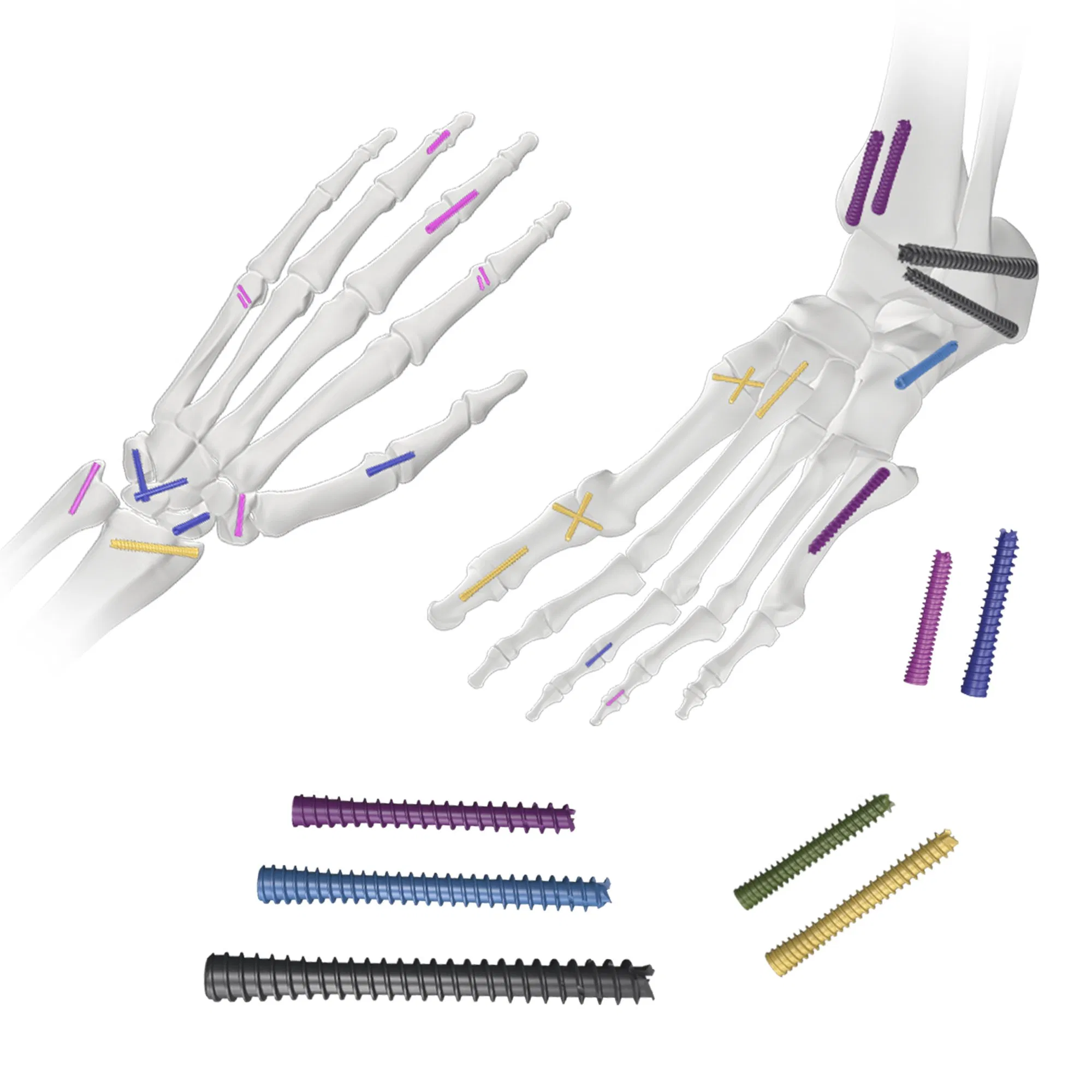 Canwell 3.0, 3.5, 4.0 Titanium Cannulated Headless Compression Screw Herbert Screw for Orthopedic Implant Trauma Screw