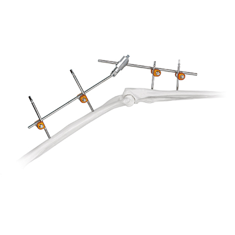 Competitive Price Orhtopedic External Fixator for Tibia Surgery