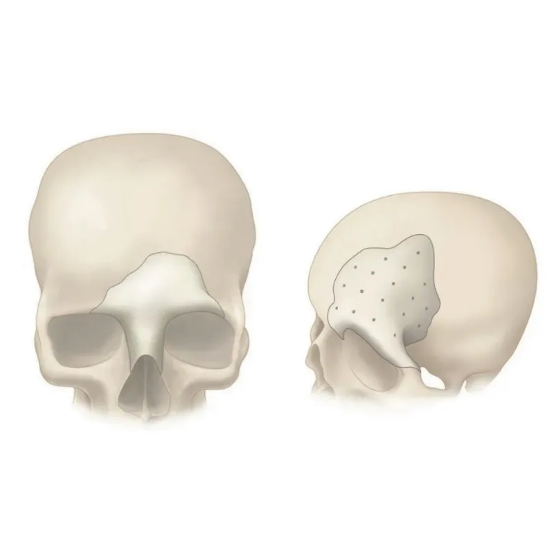 Custom Patient Specific Implant Maxillofacial Repair and Fixation System