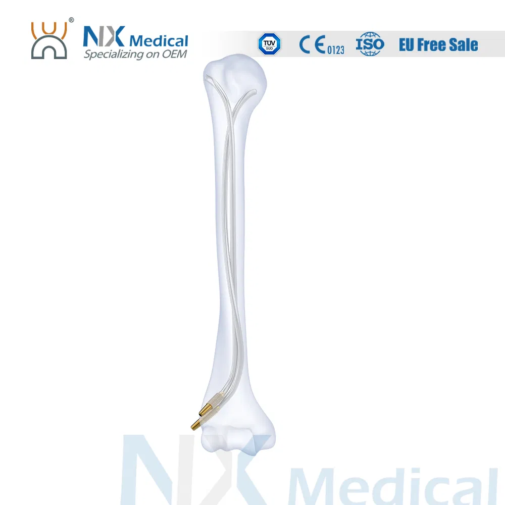 Nx Medical Orthopedic Implant Titanium Elastic Interlocking Intramedullary Nail Bone Fixation