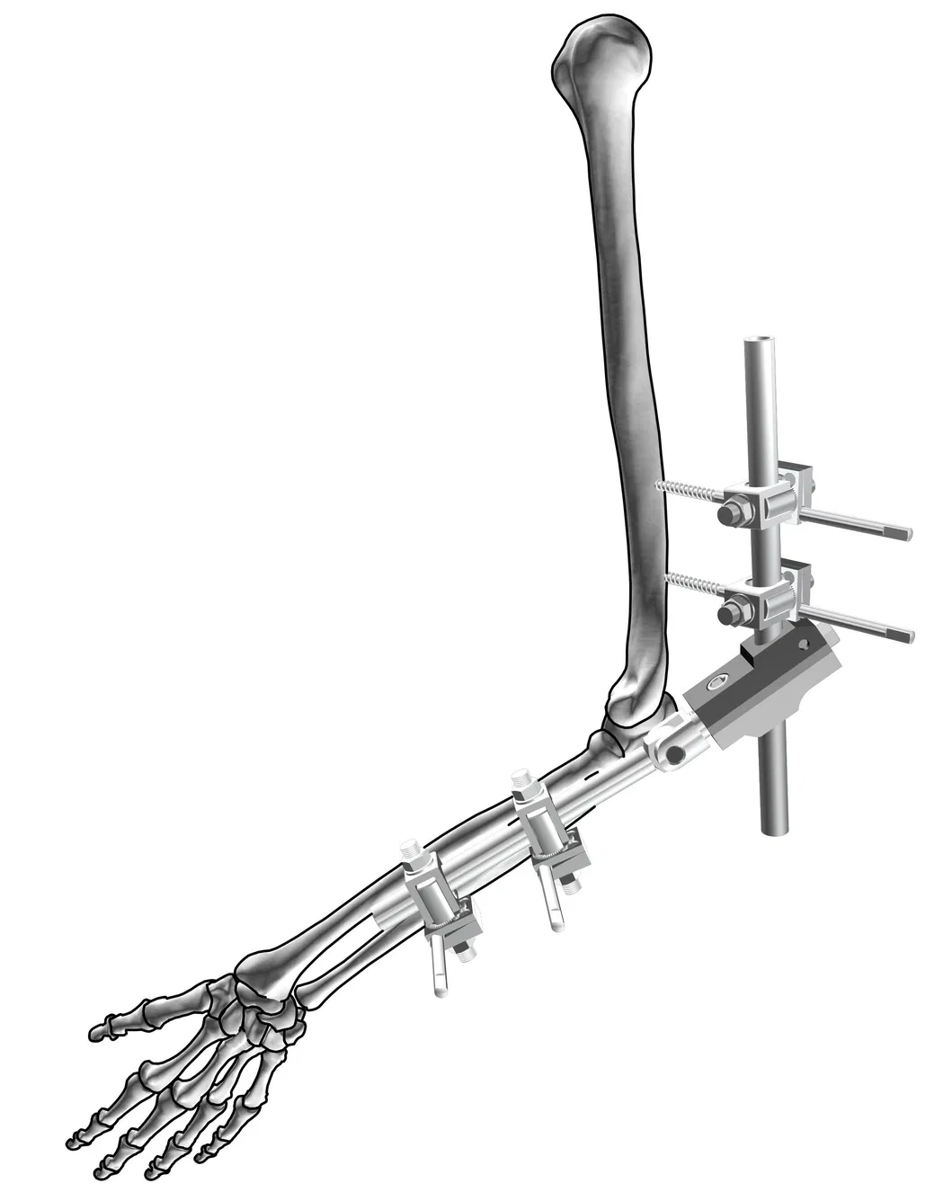 Fixator Component Detail