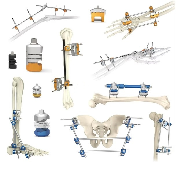 Finger Mini-Fixator Palm External Fixator Hand Bone Pin Stent External Fixator