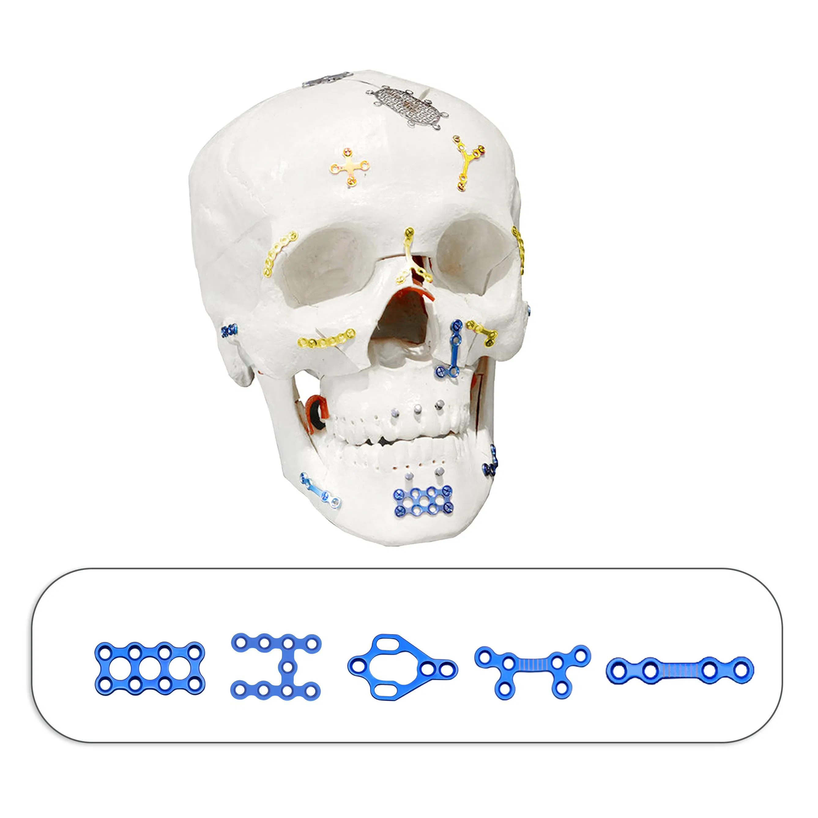 Orthopedic Implant Titanium Alloy Maxillofacial Plates and Screws Locking Plate