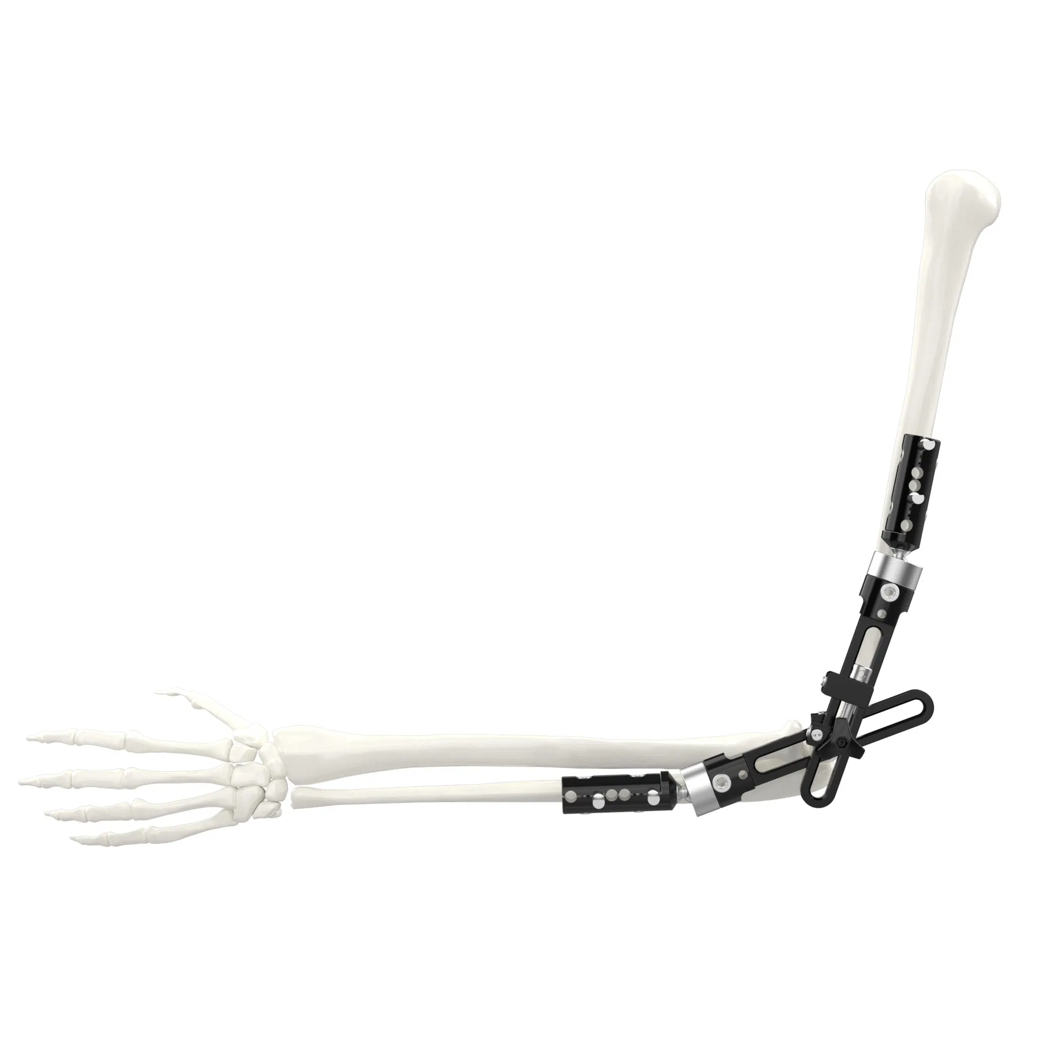 Canwell Orthopedic Trauma Implant Ilizarov Ring Fixator External Fixator Ilizarov External Fixation