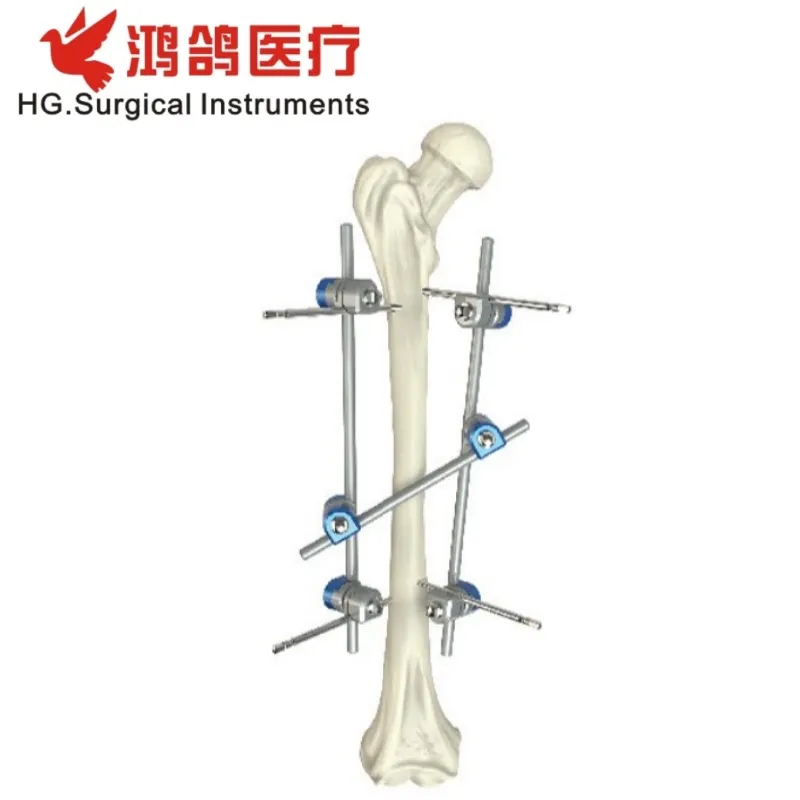 Orthopedic External Fixator 3