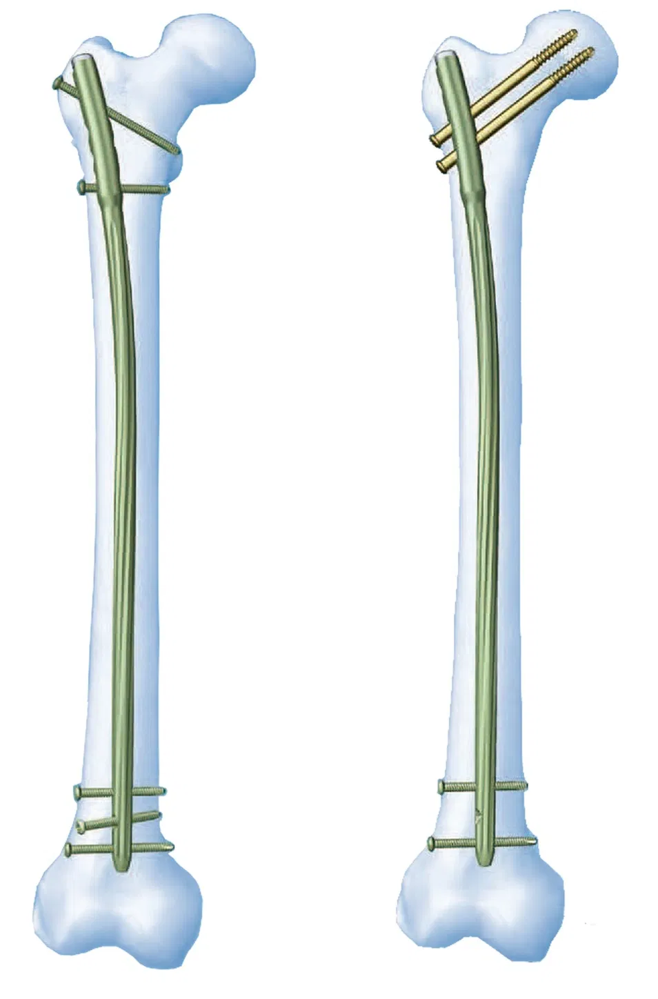 Expert Femoral Nail System