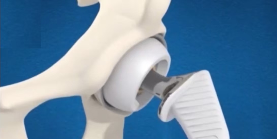 Femoral Head Option 5