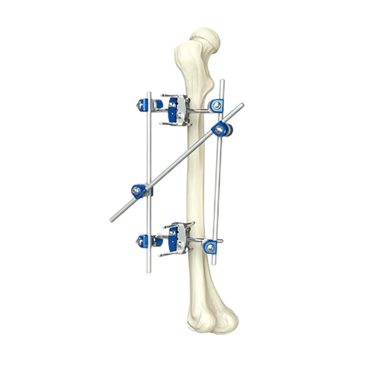 Complete Orthopedic External Fixation System Set, Full External Fixator Surgical Equipment