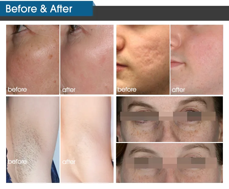 Vascular Treatment Results