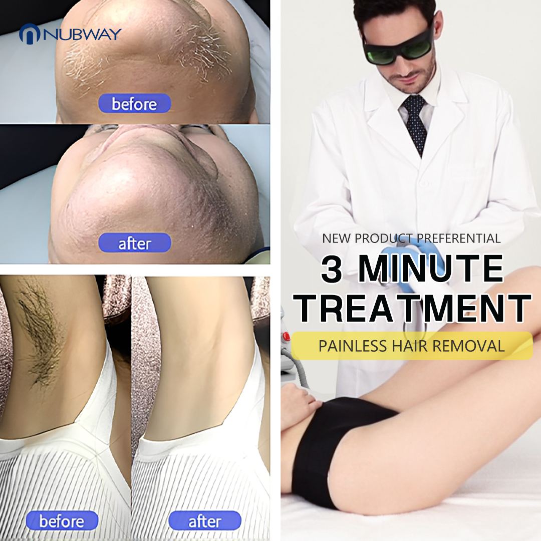 Factory OEM ODM Dual Handles Design Online Technical Support Diode Laser Hair Removal Equipment for International Beauty Market
