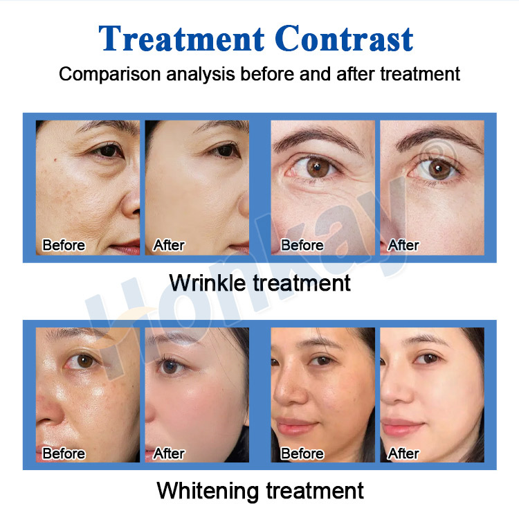 Vertical spa use Customization jet Peel Oxygen Injection and Spray Facial Hydra Water Dermabrasion Machine