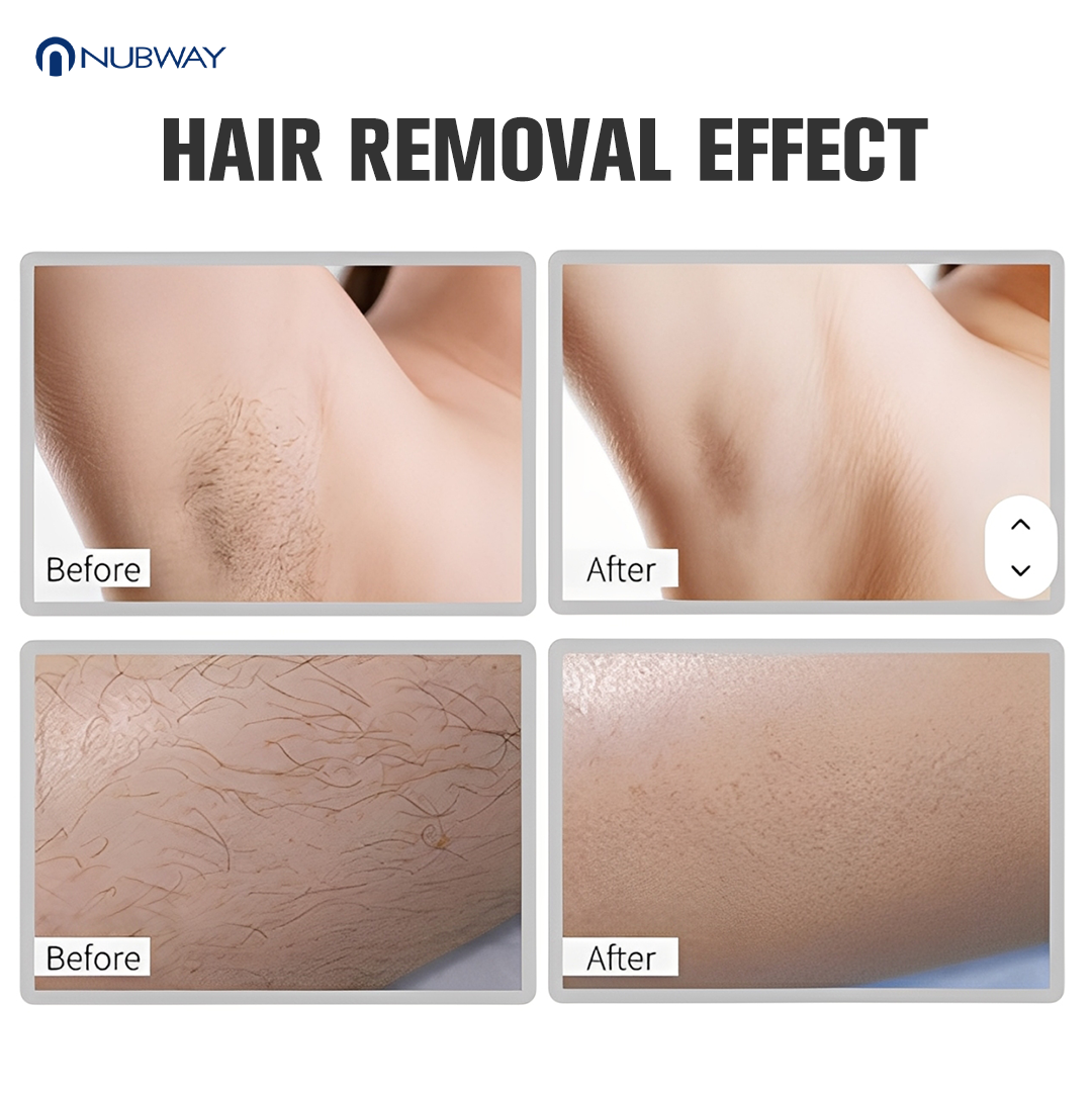 Factory OEM ODM Dual Handles Design Online Technical Support Diode Laser Hair Removal Equipment for International Beauty Market