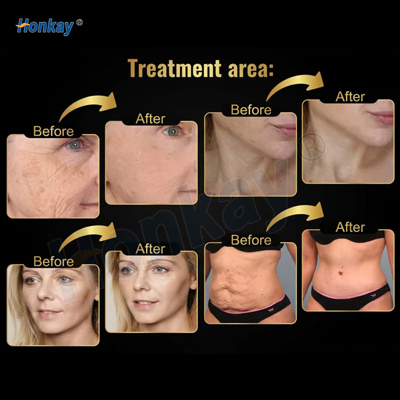 Multi-Functional Face Lift Body Shaping Machine With 2 Handles For Skin Firming Wrinkle Removal Targeted Areas