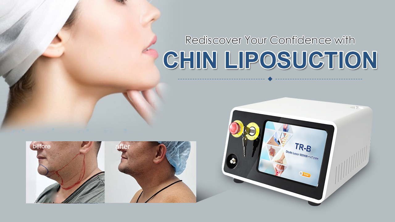 Laser Liposuction Equipment