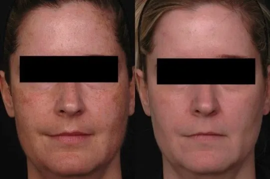 Before and After 2