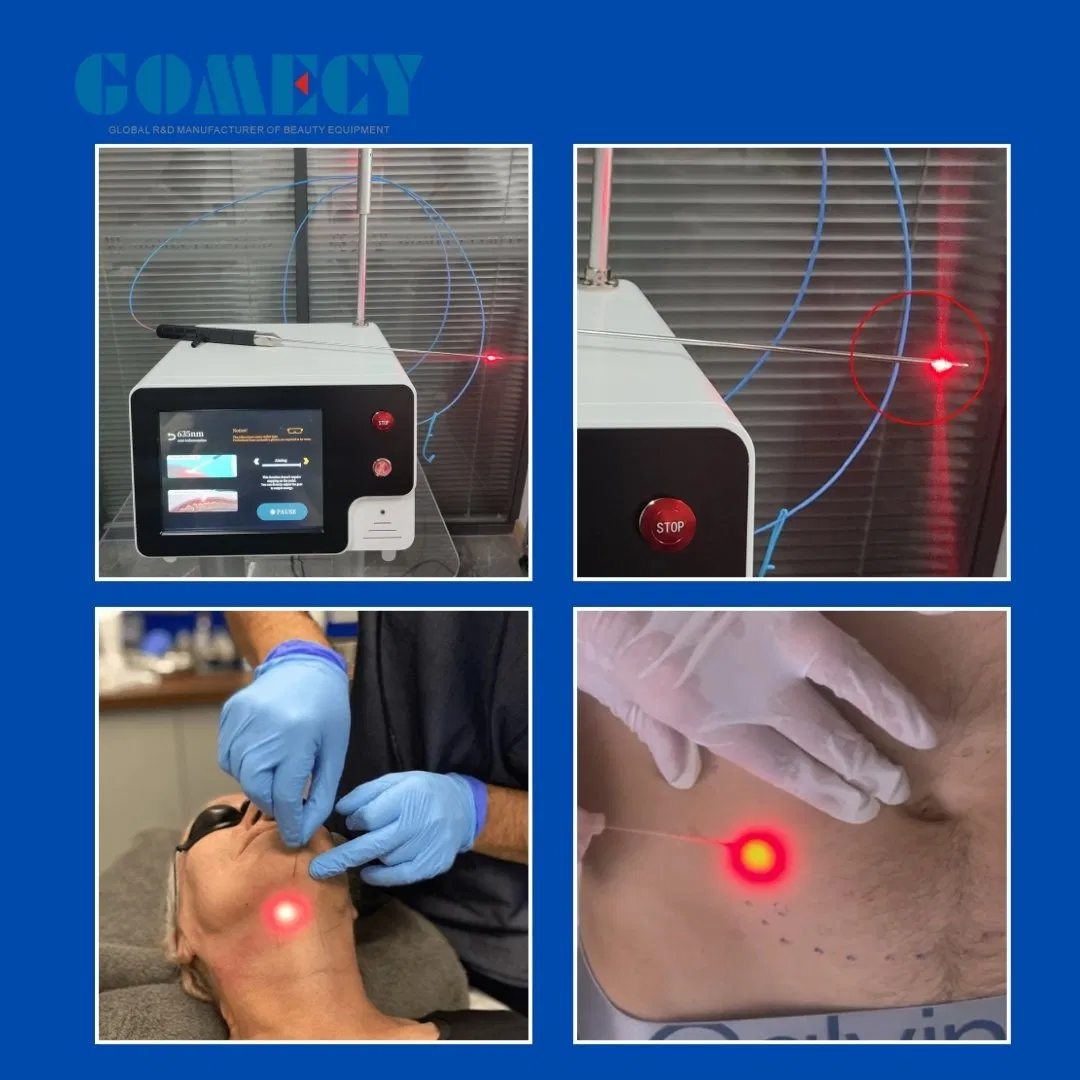 Peofessional 30W 980nm 1470nm Microsurgical Diode Laser Machine Aesthetic Laser System