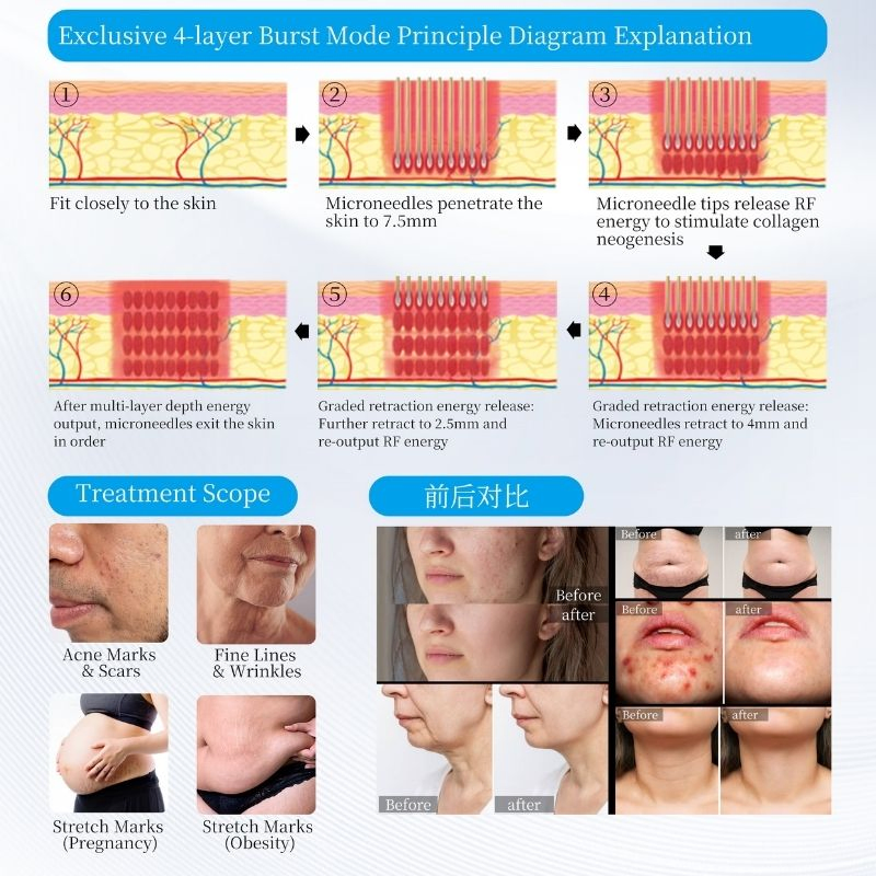 Professional M9 Ice Cooling RF Microneedle System for Skin Tightening and Rejuvenation