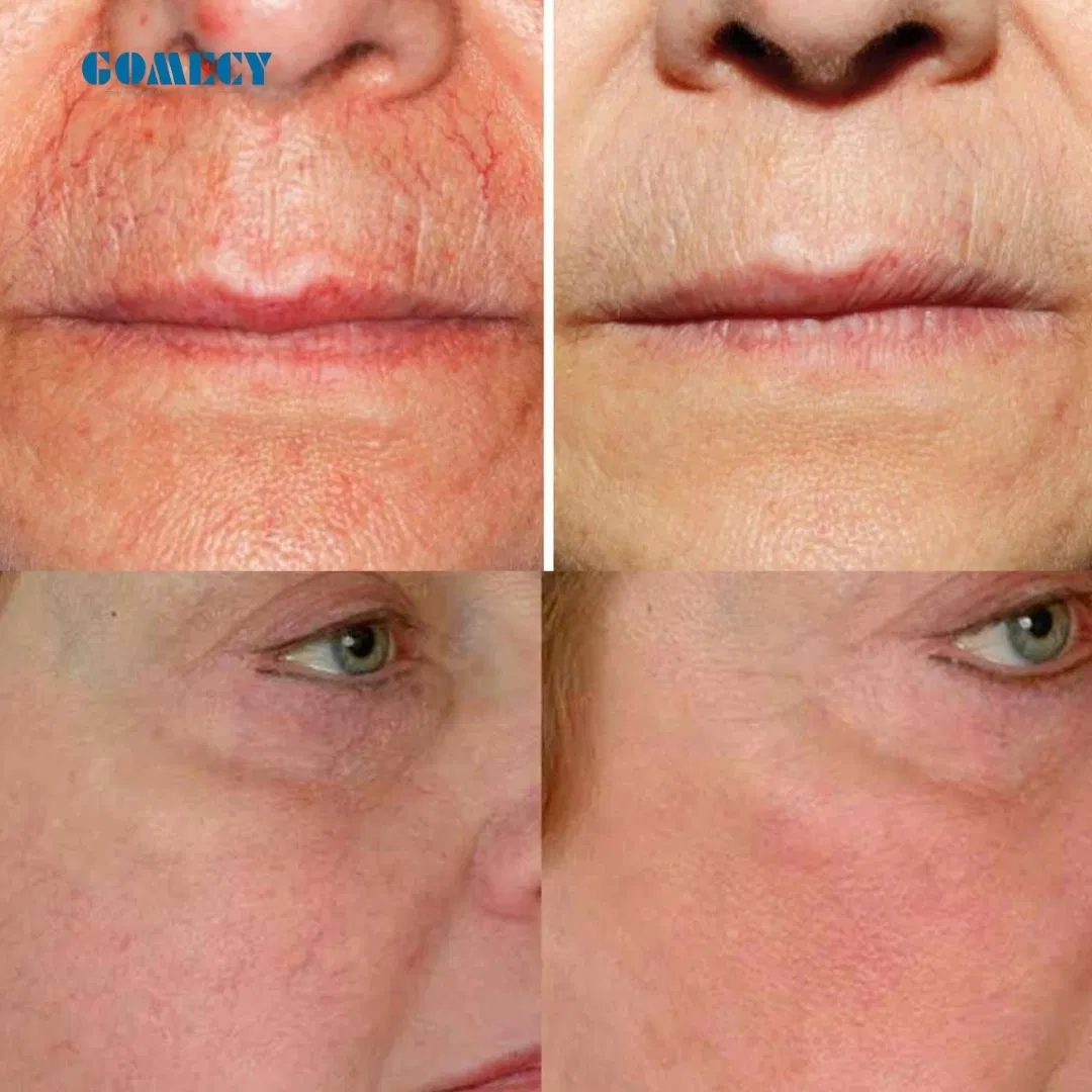 Endolaser 980 1470 Diode Laser Effective Result Vascular 980m Laser Machine System 1470nmfiber