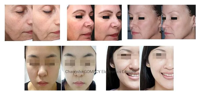 Before and After Results