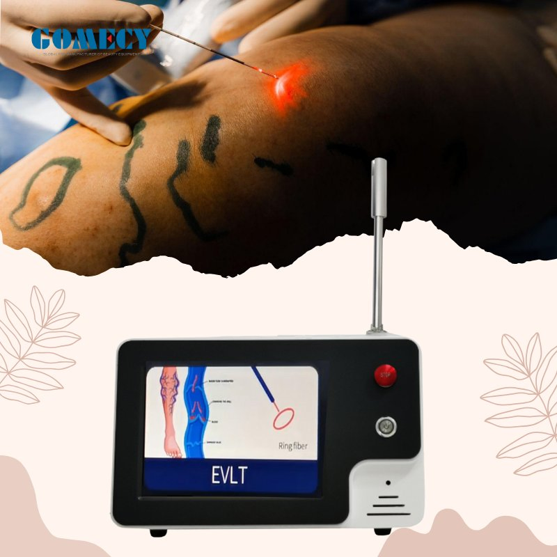 1470nm Endovenous Laser Vein Therapy System for Minimally Invasive Vascular Treatment