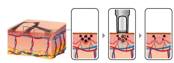Laser System Design