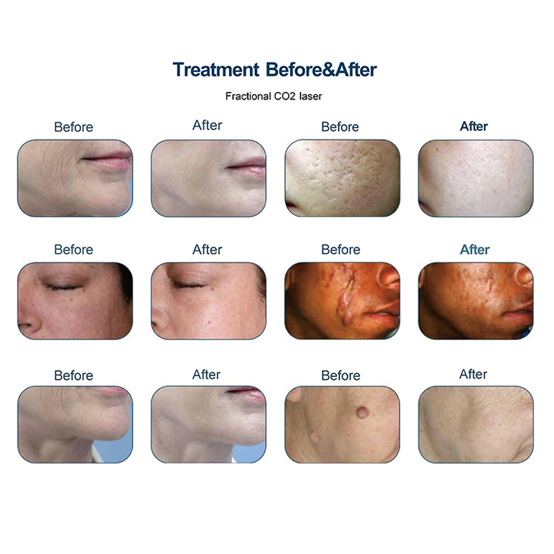 MQ Laser Salon Use Professional Fractional CO2 Laser Machine 1 Year Warranty Ice Cooling for Acne Scar Removal Wrinkle Treatment