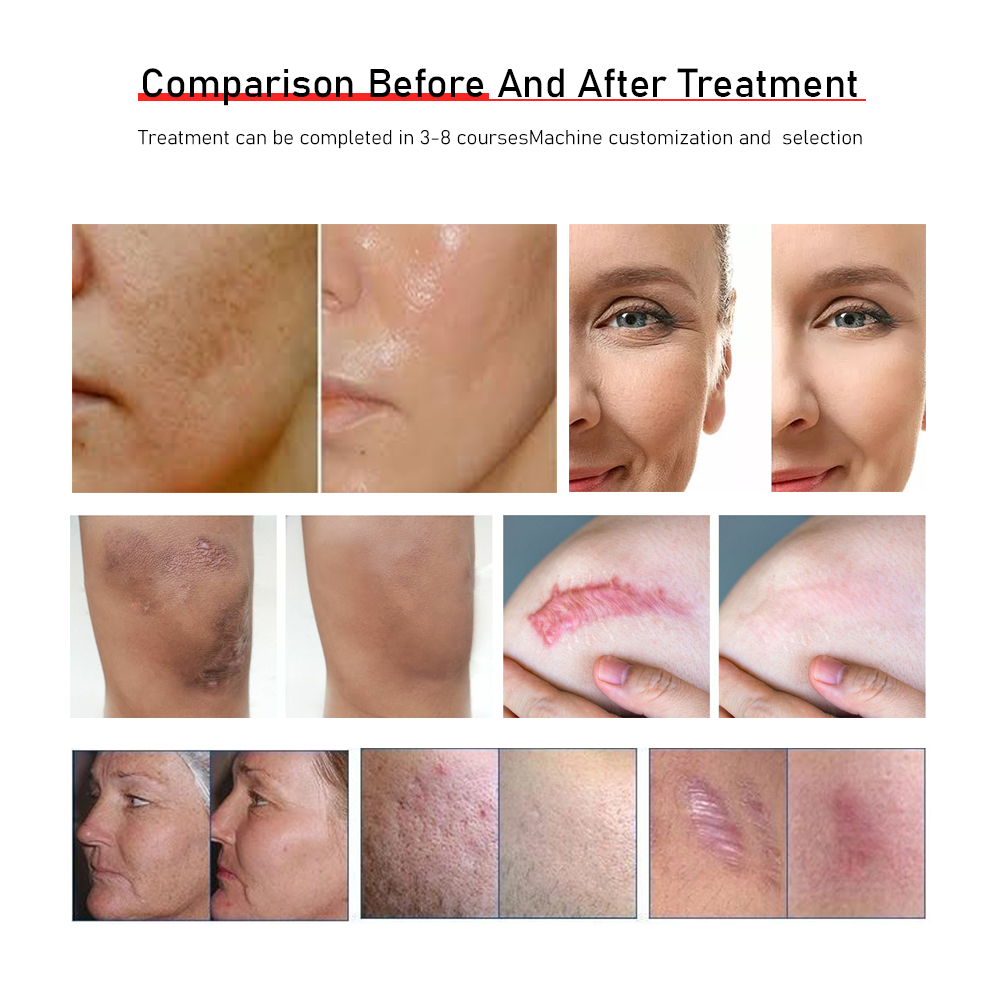 Medical Grade 10600nm CO2 Fractional Laser Machine Q-Switch Air Cooling for Skin Resurfacing Acne Scars Beauty Equipment
