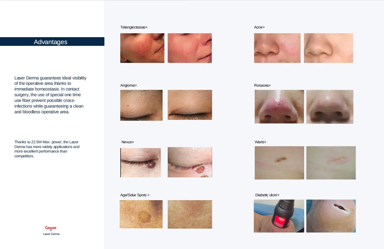 Medical Diode Laser System for Dermatology Clinics and Skin Therapy