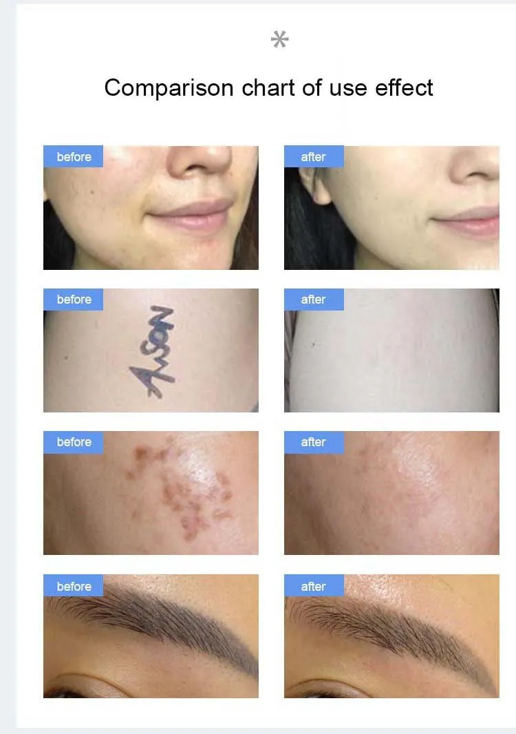 Laser Beauty System 4