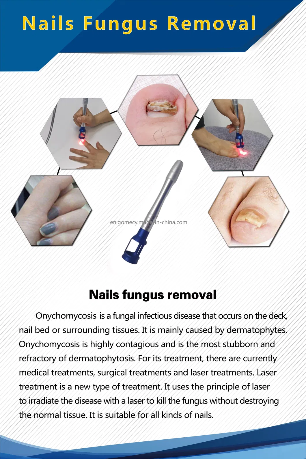 Nail Treatment