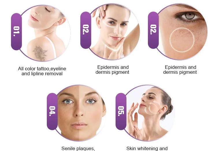 YAG Laser Treatment