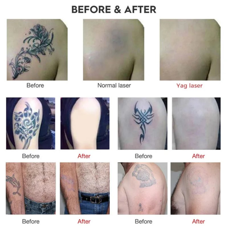 High Energy Pico Laser Q-Switched System for Carbon Peeling, Acne and Pigment Removal