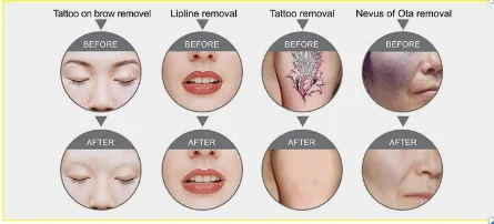 Before and After Results