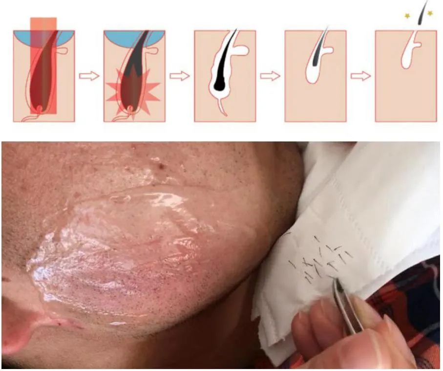 Diode Laser Application